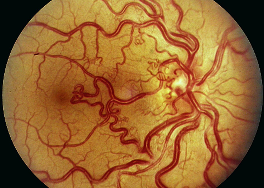 Aneurisma-arteriovenoso-de-la-retina-S-Wyburn-Mason