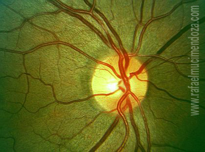 Aspecto de la retina observada con luz aneritra (red free ligth)